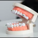 Can You Get Braces With Dental Implants