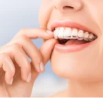 How To Tell İf İnvisalign İs Tracking
