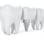 Implantat-Zahn: Die Lösung bei Zahnverlust
