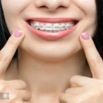 The Benefits of Braces for a Perfect Smile