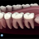 The Most Common Symptoms of Wisdom Teeth Infection After Removal