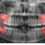 does wisdom teeth removal hurt