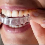how long does invisalign take