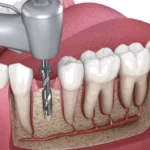 Severe Pain During Root Canal Treatment