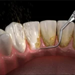 Como prevenir o tártaro nos dentes?
