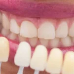 Conoce los diferentes tipos de carillas dentales y cuál es la más adecuada para ti