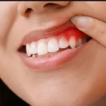 How Long Can You Keep Your Teeth With Periodontal Disease