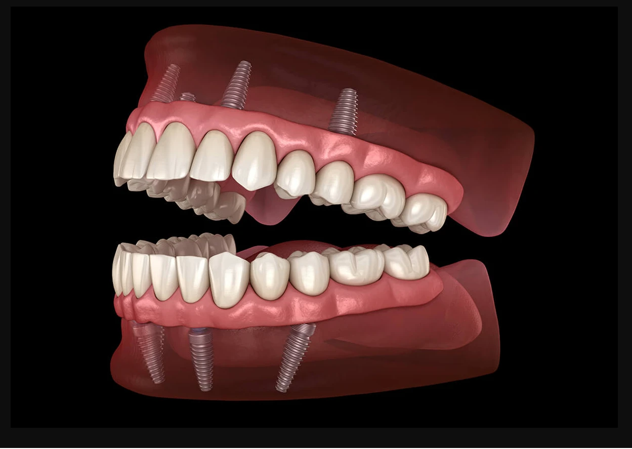 How to Care for Your Dental Implants and Ensure Long-Term Success