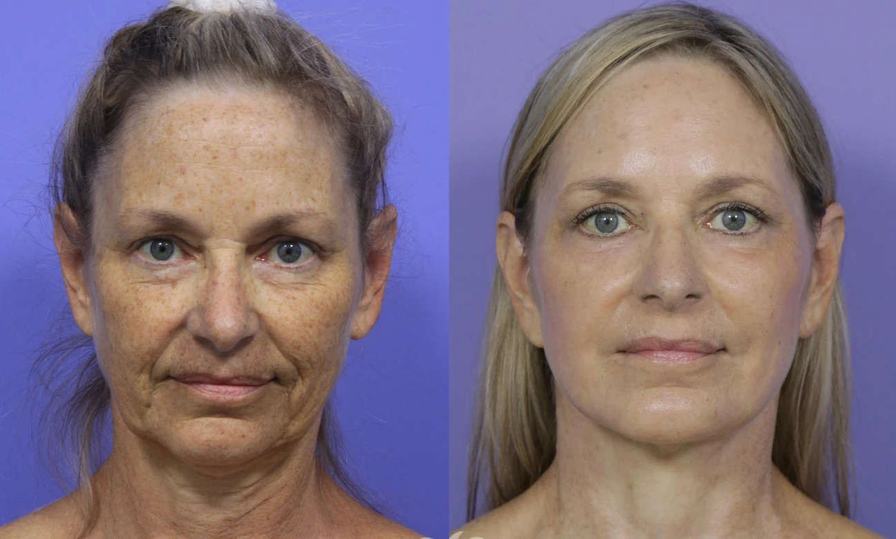 Neck Lift Before And After