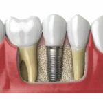 The Advantages of Getting Dental Implants and Why You Should Consider Them