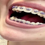 dark purple braces