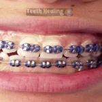 Why Purple Braces Are the Latest Trend in Orthodontics